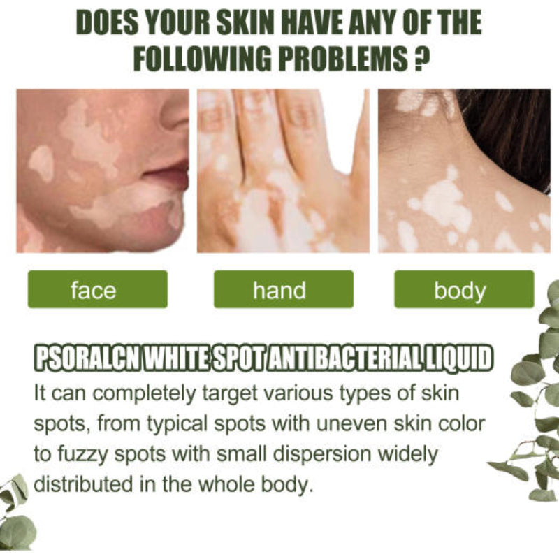 EELHOE Vitiligo Psoralcn White Spot Remove Serum ( BUY 1 GET 1 FREE)