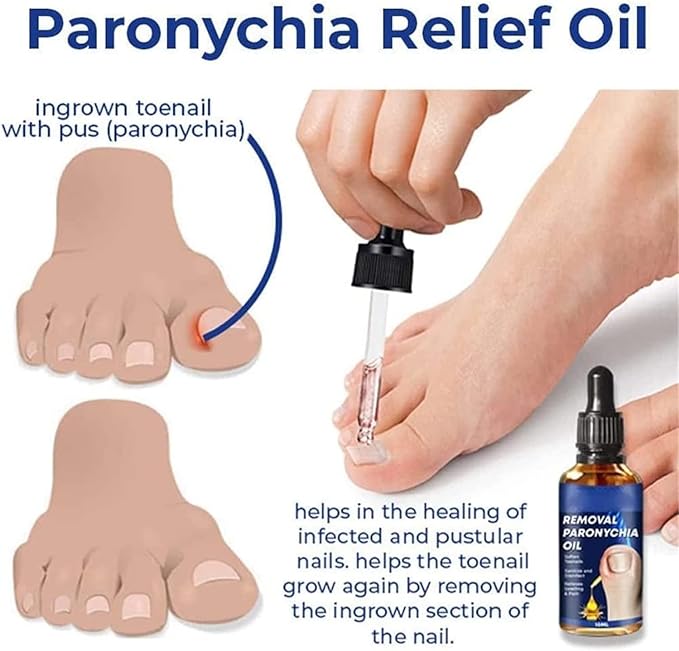 Removal Paronychia Oil ( BUY 1 GET 1 FREE )
