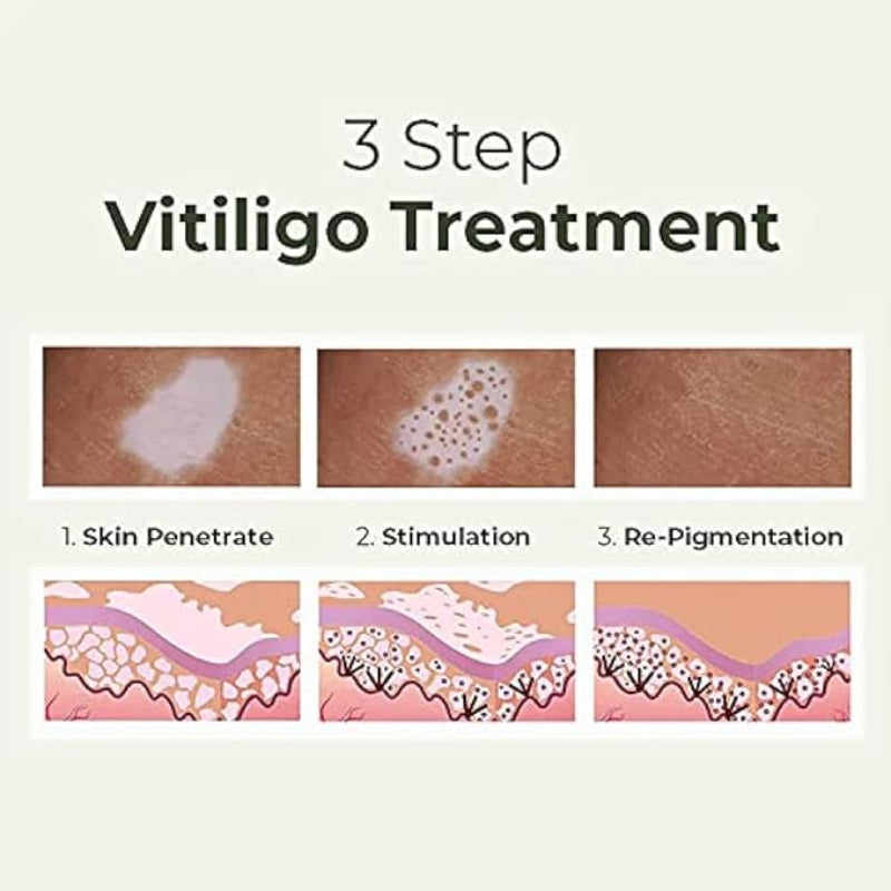 EELHOE Vitiligo Psoralcn White Spot Remove Serum ( BUY 1 GET 1 FREE)