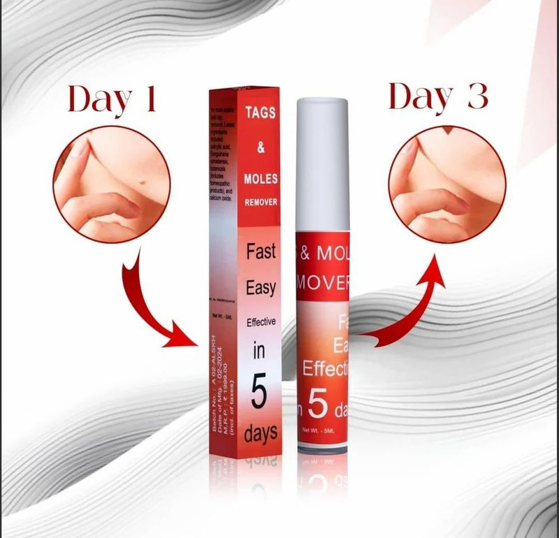 LOVILDS™ Tags & Moles Remover (Buy 1 Get 1 Free🔥🔥)