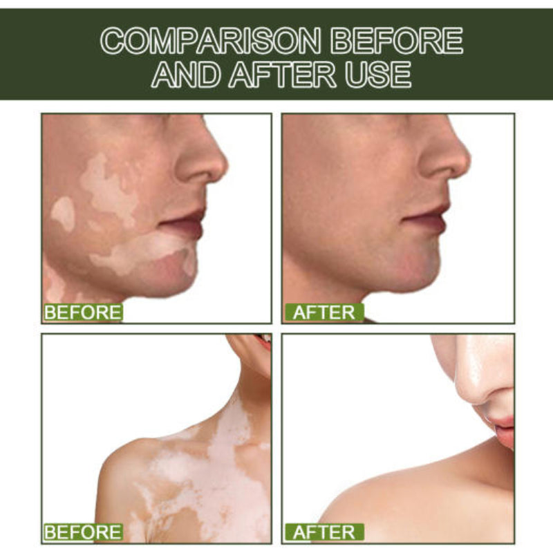 EELHOE Vitiligo Psoralcn White Spot Remove Serum ( BUY 1 GET 1 FREE)
