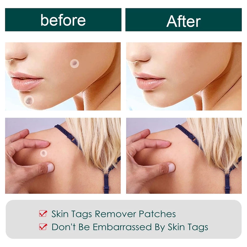 20PCS/Box Warts Remover Patch Safe Painless Skin Tags Patches Wart Treatment Patch Fast Acting Remover Warts Moles