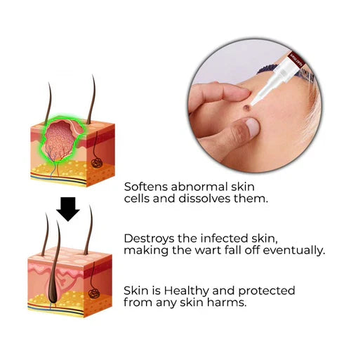 LOVILDS™ Tags & Moles Remover (Buy 1 Get 1 Free🔥🔥)