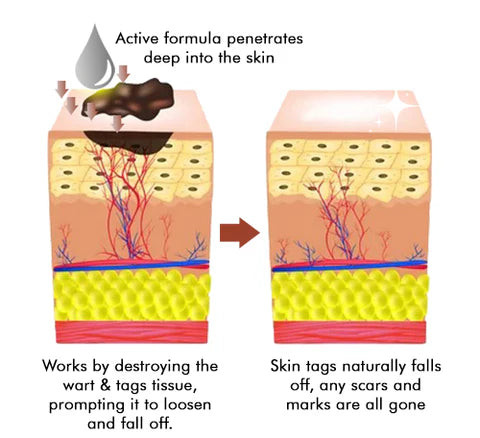 LOVILDS™ Tags & Moles Remover (Buy 1 Get 1 Free🔥🔥)