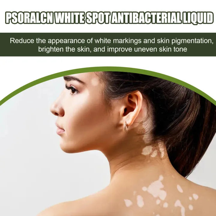 EELHOE Vitiligo Psoralcn White Spot Remove Serum ( BUY 1 GET 1 FREE)
