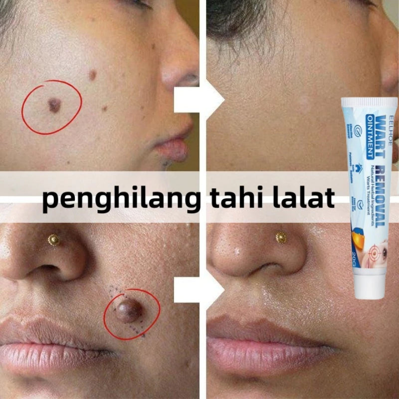 Wart Remover Ointment - Effective Cream( BUY 1 GET 1 FREE )