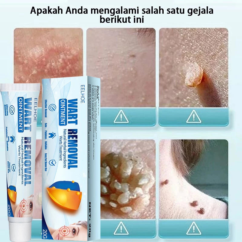 Wart Remover Ointment - Effective Cream( BUY 1 GET 1 FREE )