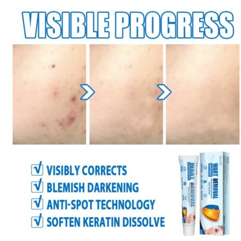 Wart Remover Ointment - Effective Cream( BUY 1 GET 1 FREE )