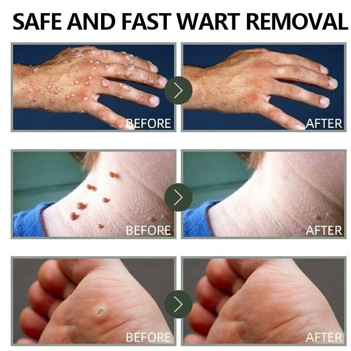 Wart Remover Ointment - Effective Cream( BUY 1 GET 1 FREE )