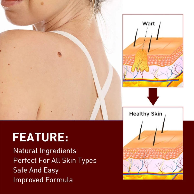 LOVILDS™ Tags & Moles Remover (Buy 1 Get 1 Free🔥🔥)